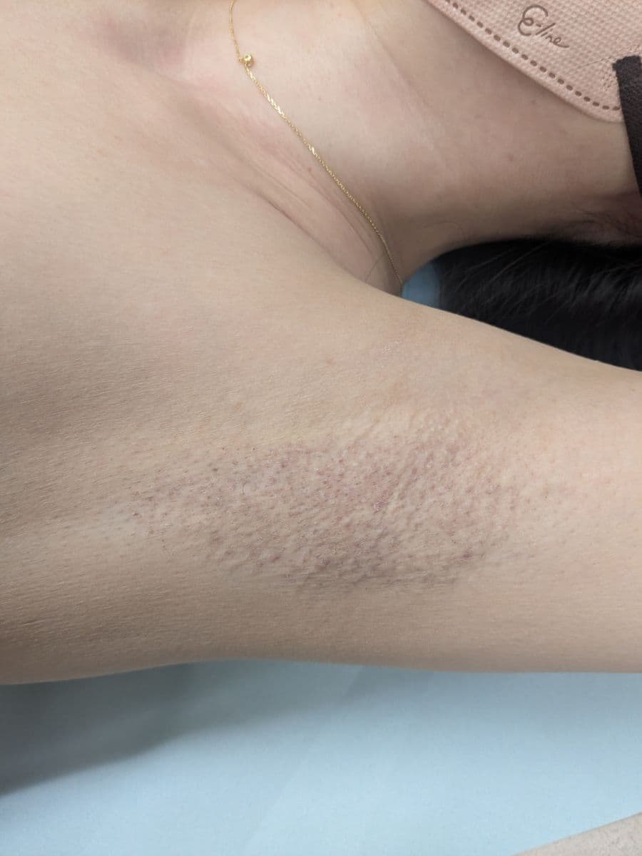 福岡のビューホット他院修正症例 32歳女性 施術後14日目の左わきの状態