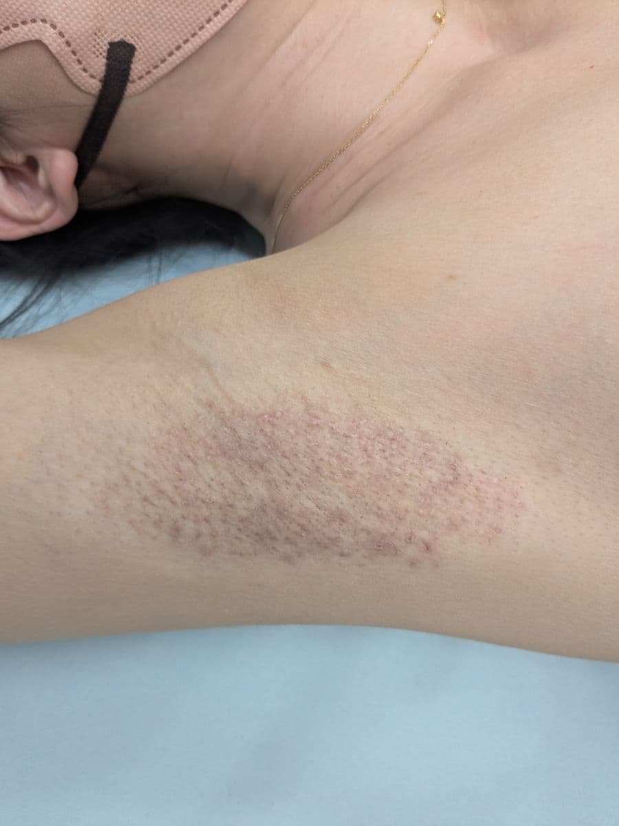 福岡のビューホット他院修正症例 32歳女性 施術後14日目の右わきの状態