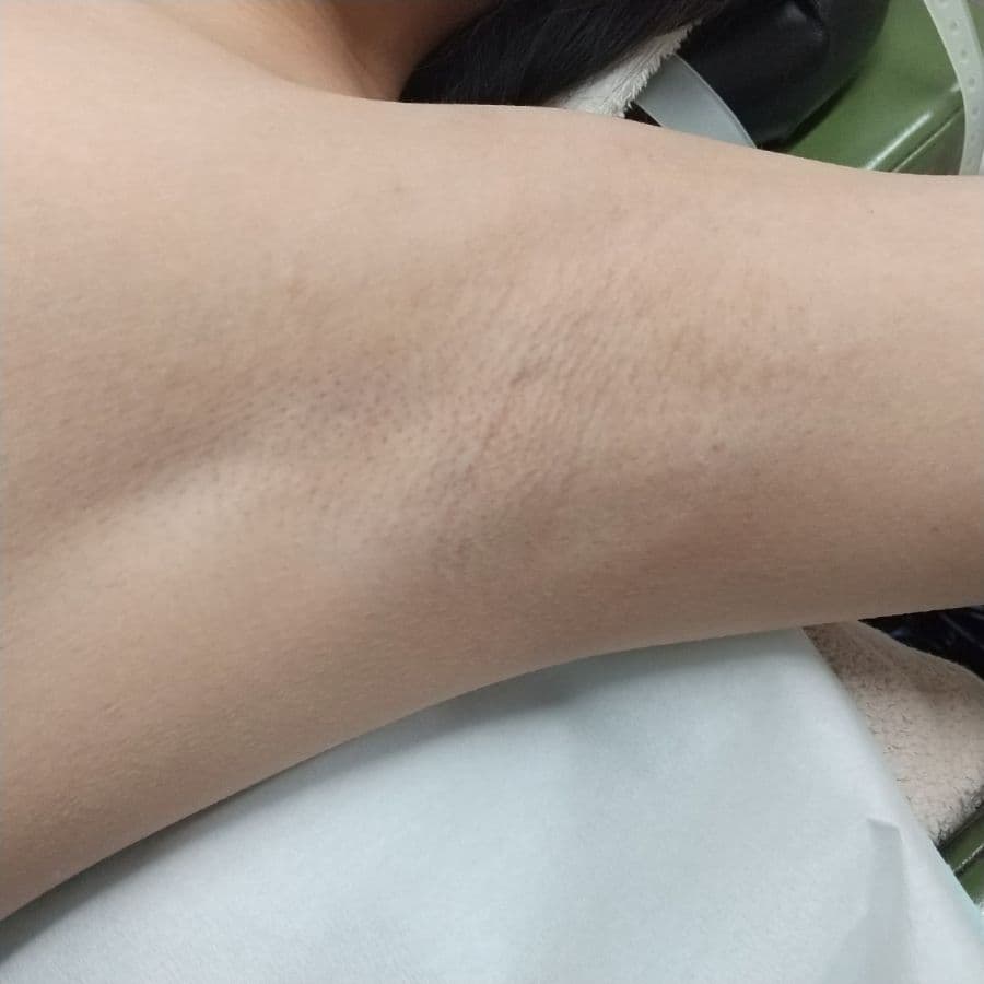 福岡のビューホット他院修正症例 32歳女性 施術前の左わきの状態