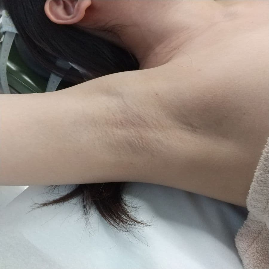 福岡のビューホット他院修正症例 32歳女性 施術前の右わきの状態