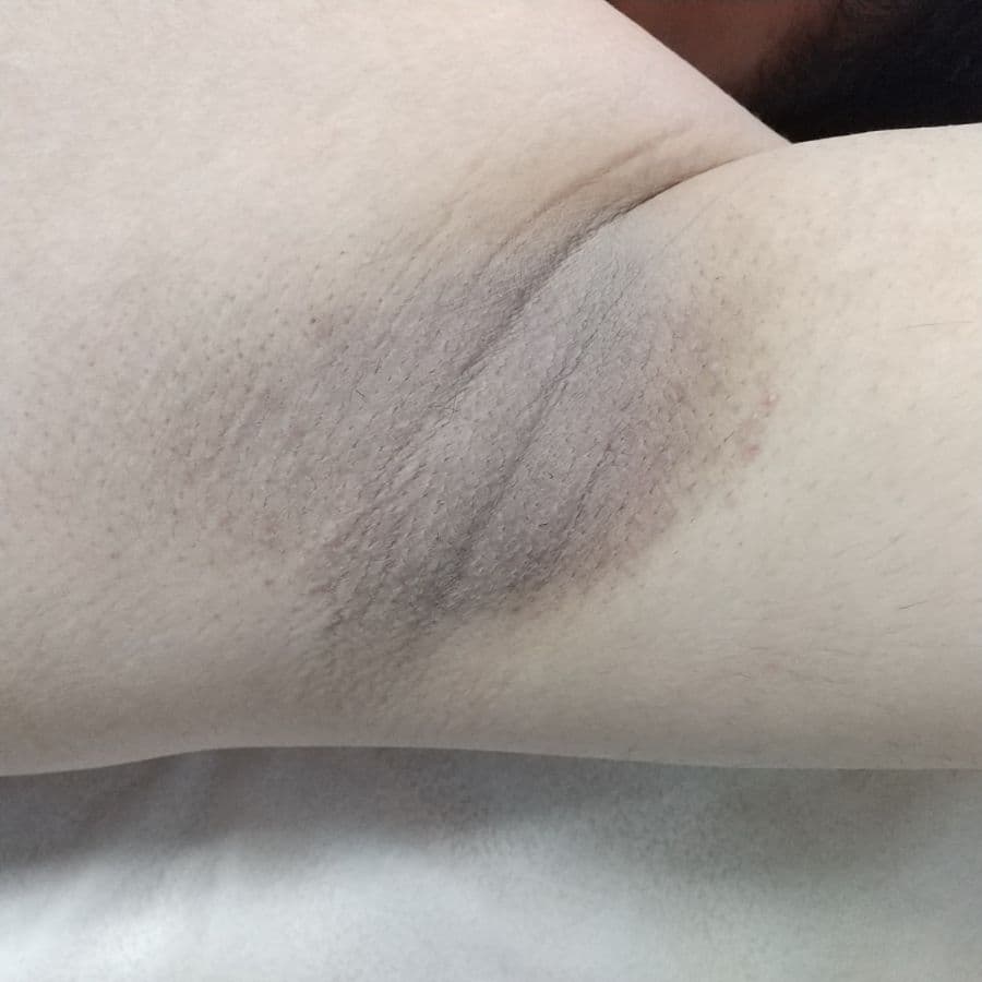 福岡のメンズワキガ治療症例 33歳男性 施術後14日目の左わきの状態