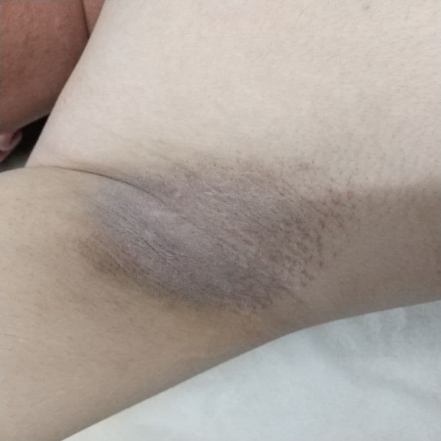 福岡のメンズワキガ治療症例 33歳男性 施術後14日目の右わきの状態