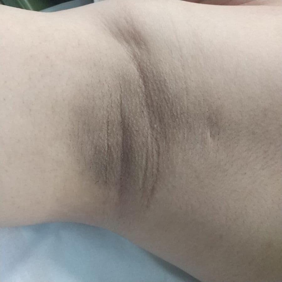 福岡のメンズワキガ治療症例 33歳男性 施術前の右わきの状態