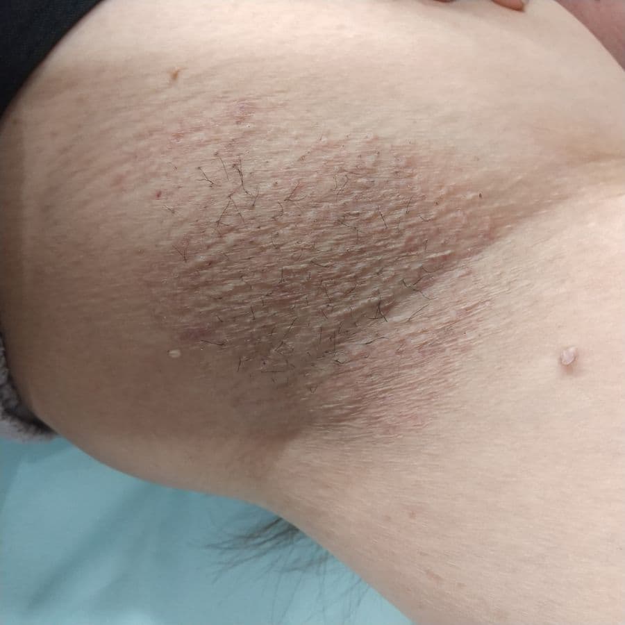 福岡の50代女性ワキガ治療症例 施術後14日目の左わきの状態