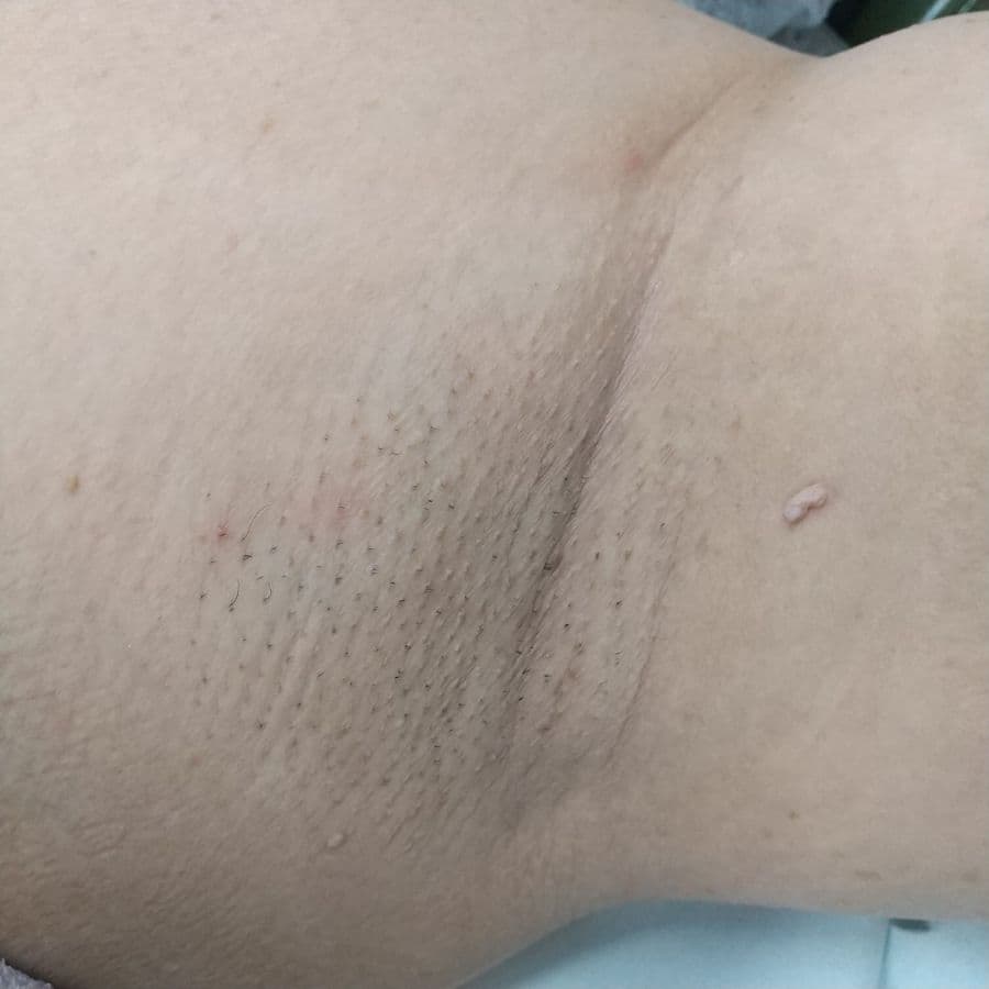 福岡の50代女性ワキガ治療症例 施術前の左わきの状態