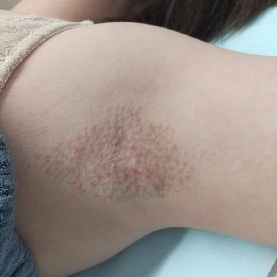 福岡のワキガ他院修正症例 53歳女性 施術後14日目の左わきの状態