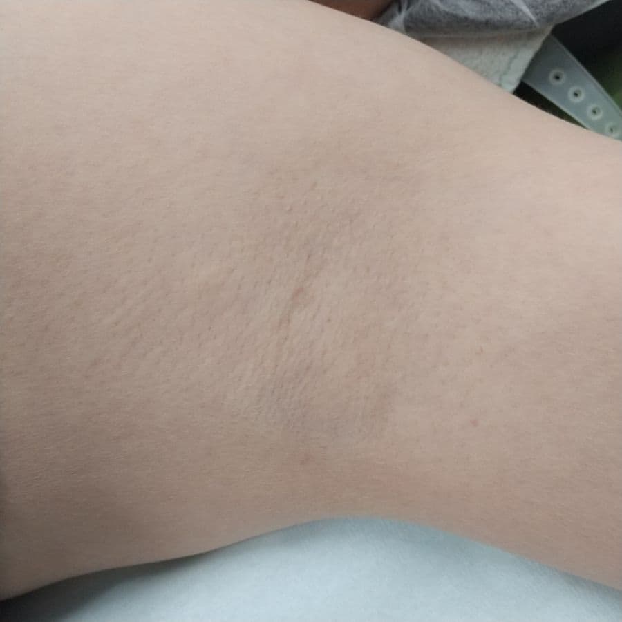 福岡のワキガ他院修正症例 53歳女性 施術前の左わきの状態