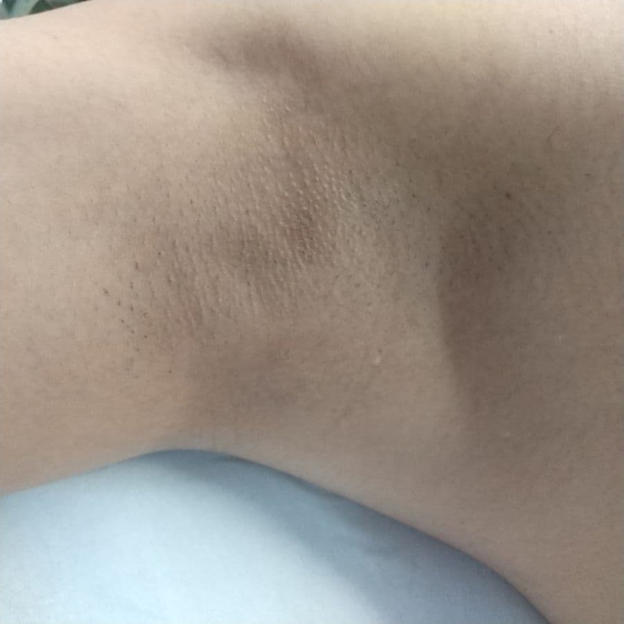 福岡のメンズワキガ治療症例 47歳男性 施術前の右わきの状態