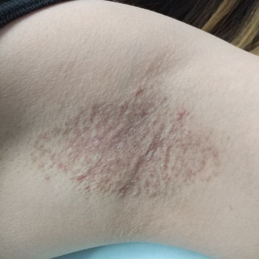 福岡のワキガ他院修正症例 34歳女性 施術後14日目の左わきの状態