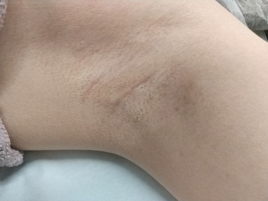福岡のワキガ他院修正症例 34歳女性 施術前の左わきの状態
