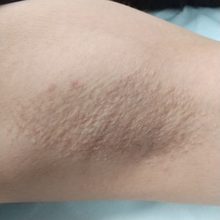 福岡のワキガ・多汗症治療症例 40歳女性 施術後14日目の左わきの状態