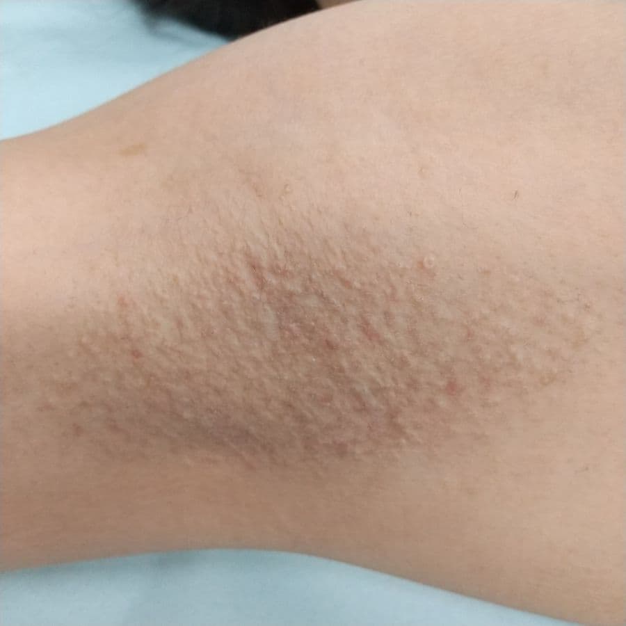 福岡のワキガ・多汗症治療症例 40歳女性 施術後14日目の右わきの状態