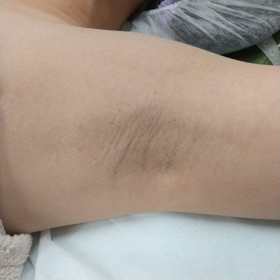 福岡のワキガ・多汗症治療症例 40歳女性 施術前の左わきの状態