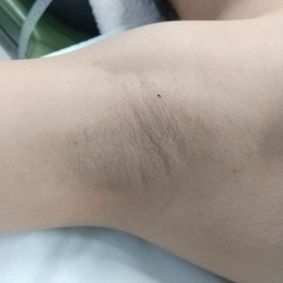 福岡のワキガ・多汗症治療症例 40歳女性 施術前の右わきの状態