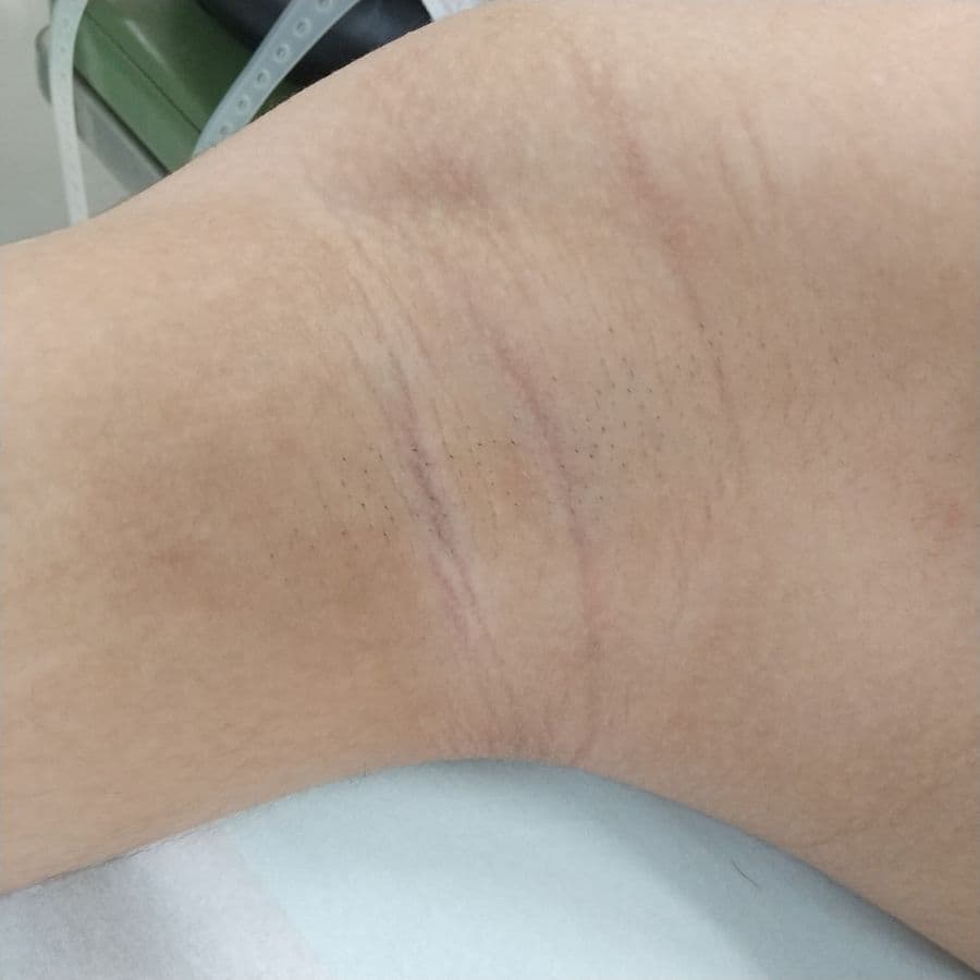 福岡のメンズワキガ他院修正症例 32歳男性 施術後14日目の右わきの状態