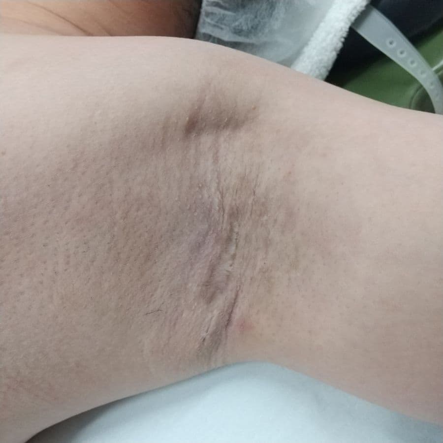 福岡のメンズワキガ他院修正症例 32歳男性 施術前の左わきの状態