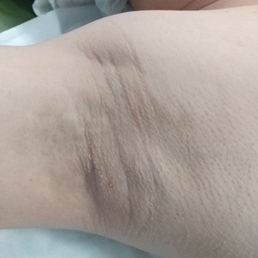福岡のメンズワキガ他院修正症例 32歳男性 施術前の右わきの状態