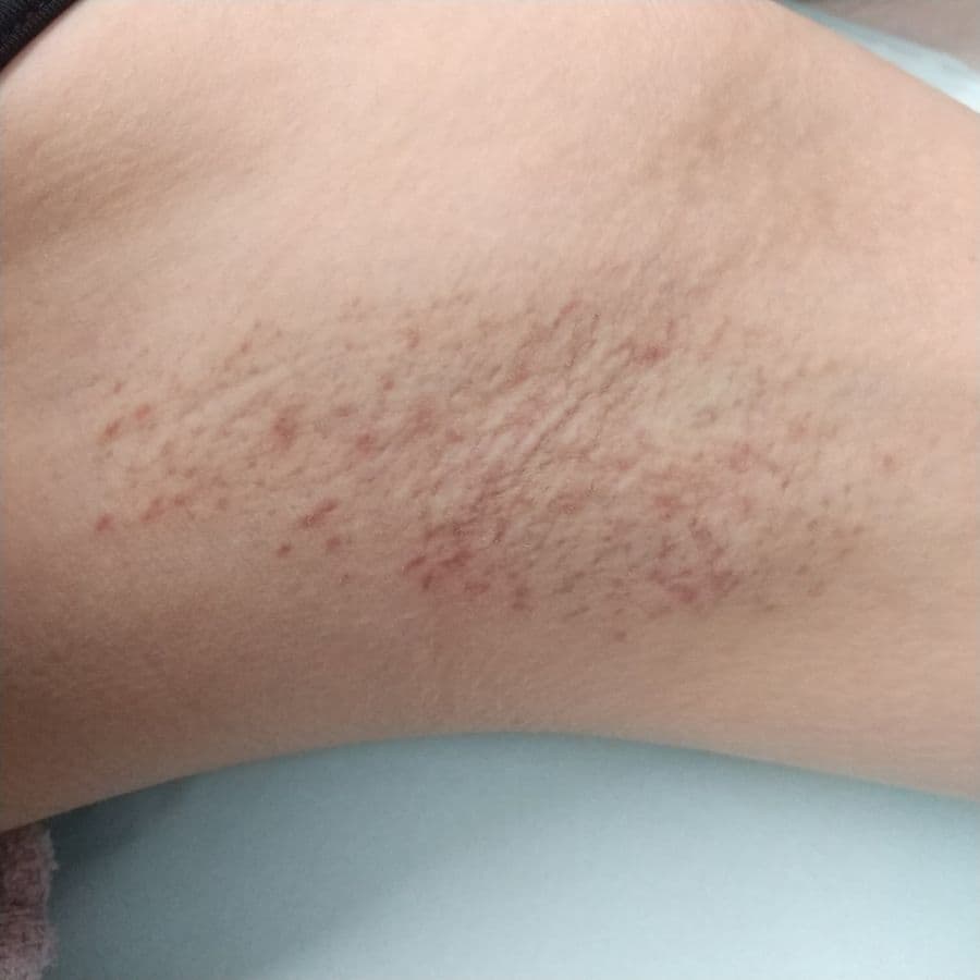 福岡のビューホット症例 28歳女性 施術後14日目の左わきの状態