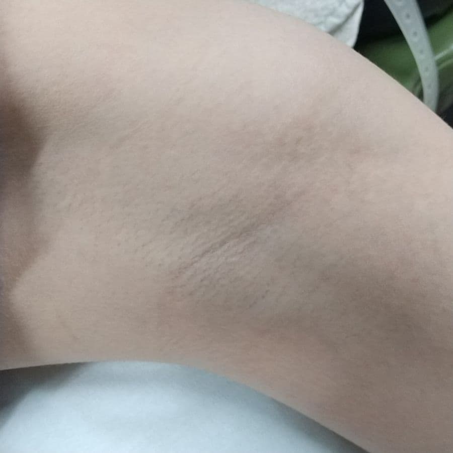 福岡のビューホット症例 28歳女性 施術前の左わきの状態