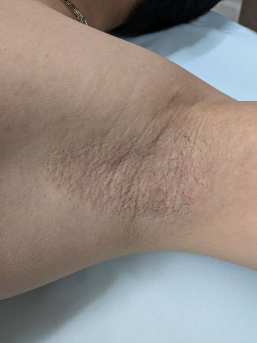 福岡のメンズワキガ治療症例 42歳男性 施術後14日目の左わきの状態