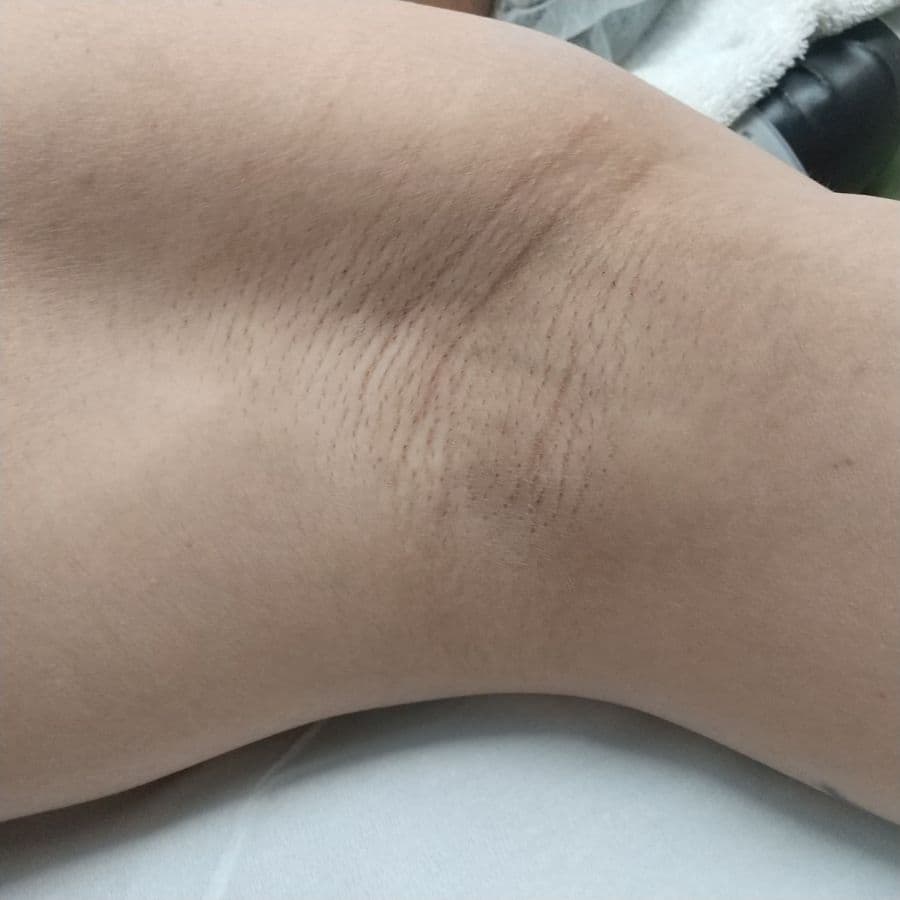 福岡のメンズワキガ治療症例 42歳男性 施術前の左わきの状態