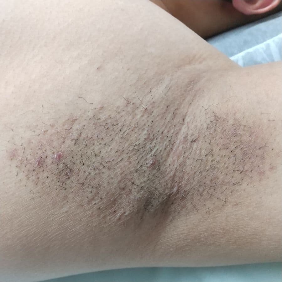 福岡のワキガ他院修正症例 43歳男性 施術後14日目の左わきの状態