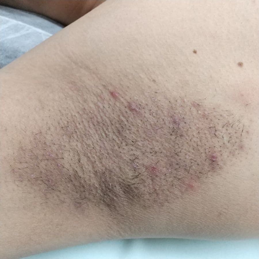 福岡のワキガ他院修正症例 43歳男性 施術後14日目の右わきの状態