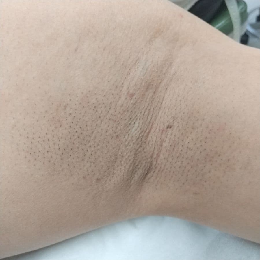 福岡のワキガ他院修正症例 43歳男性 施術前の左わきの状態