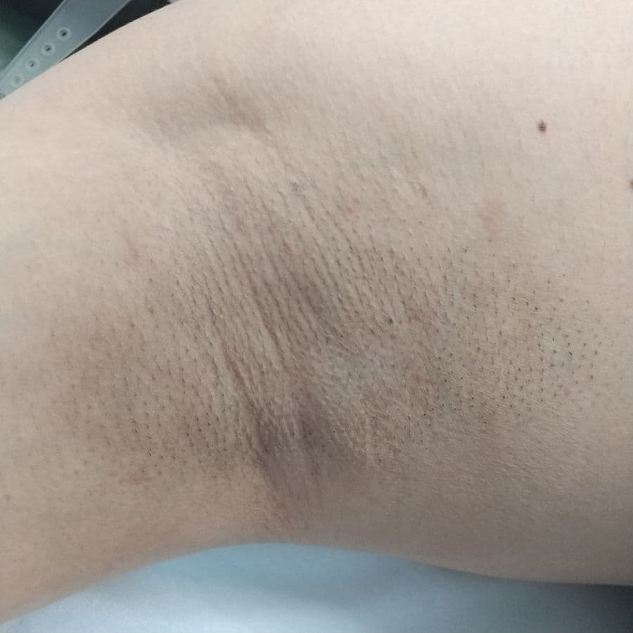 福岡のワキガ他院修正症例 43歳男性 施術前の右わきの状態