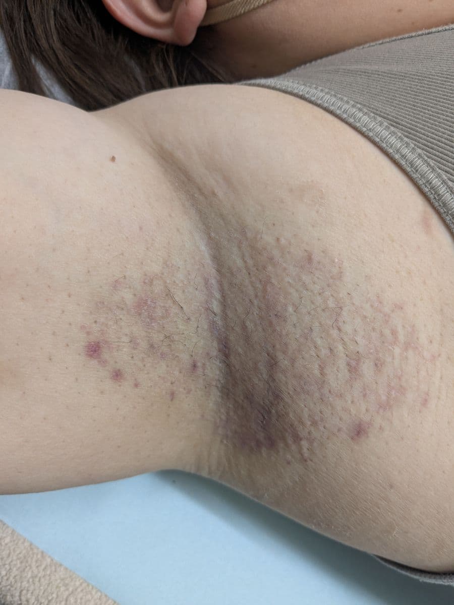 福岡のビューホット症例 39歳女性 施術後14日目の右わきの状態