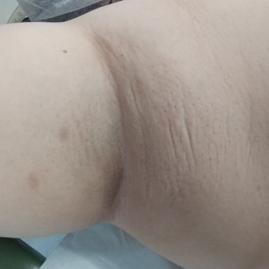 福岡のビューホット症例 39歳女性 施術前の右わきの状態