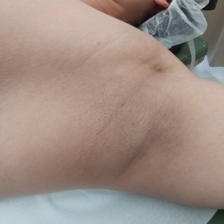 福岡のワキガ・多汗症治療症例 37歳男性 施術前の左わきの状態
