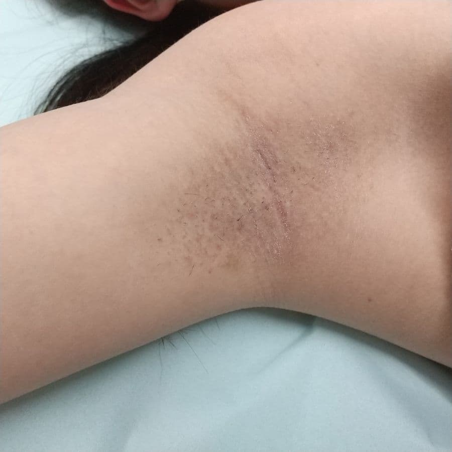 福岡の高校生ワキガ治療症例 18歳女性 施術後14日目の右わきの状態