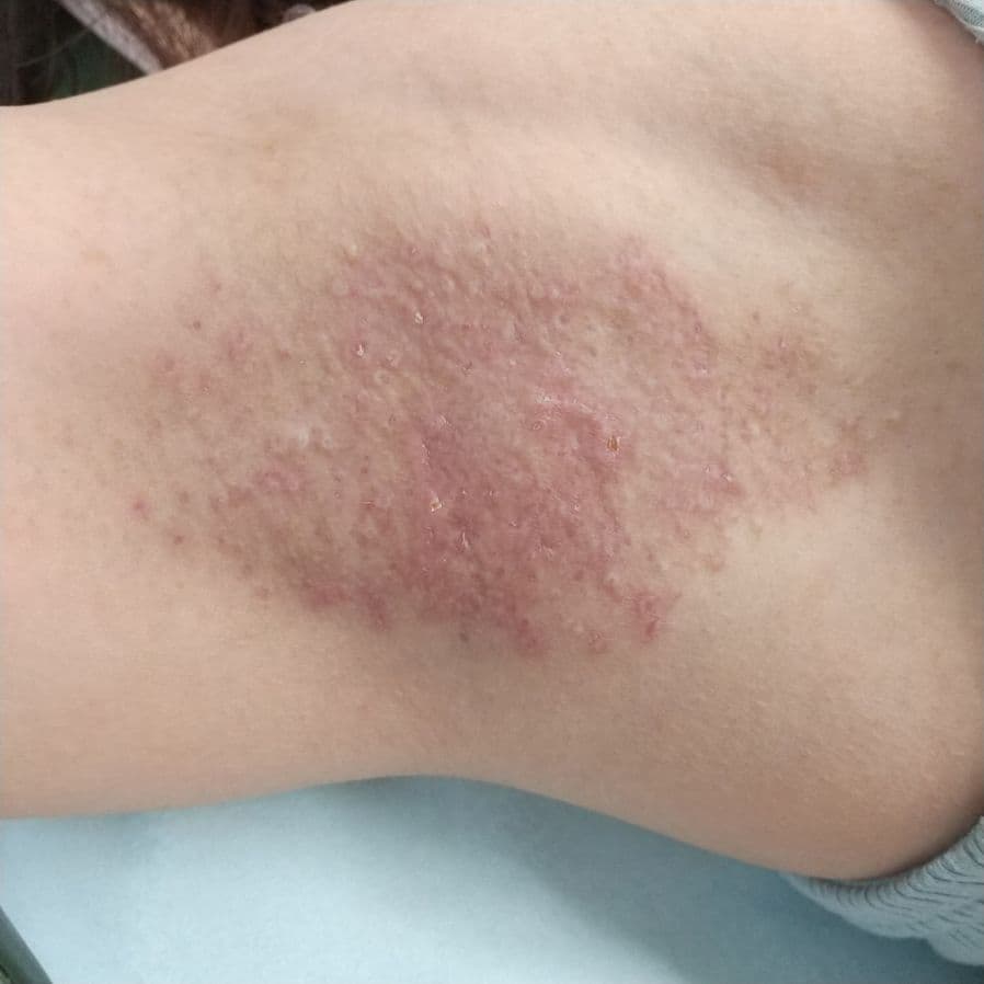 福岡のワキガ他院修正症例 39歳女性 施術後14日目の右わきの状態