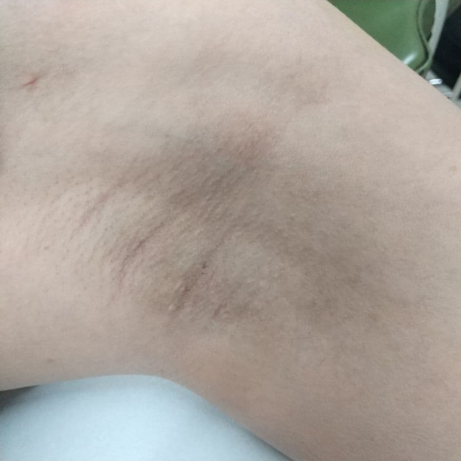 福岡のワキガ他院修正症例 39歳女性 施術前の左わきの状態