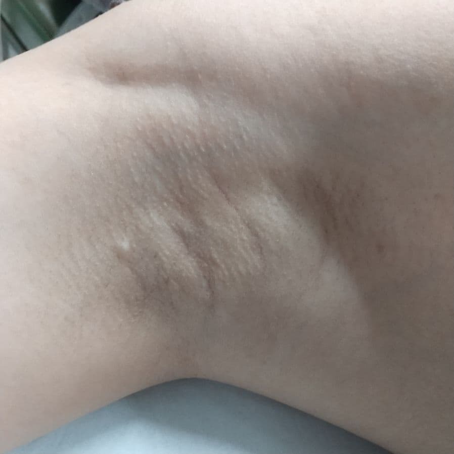 福岡のワキガ他院修正症例 39歳女性 施術前の右わきの状態