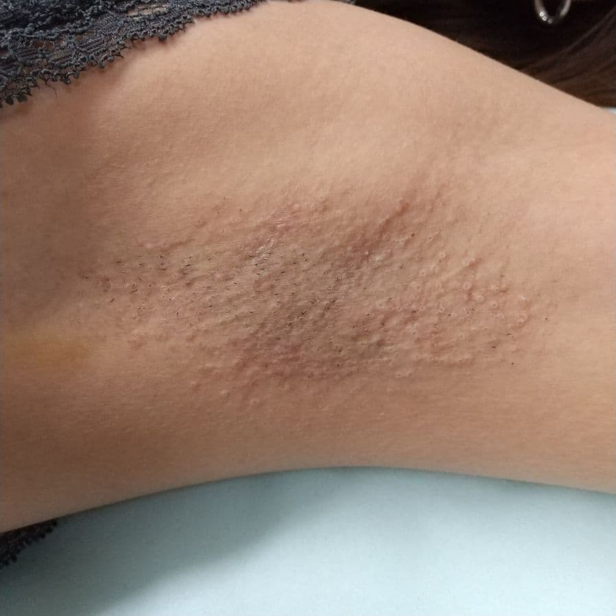 福岡のワキガ治療症例 32歳女性 施術後14日目の左わきの状態