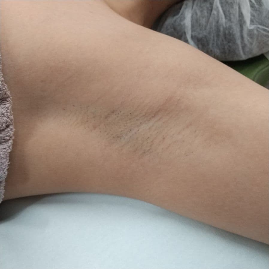 福岡のワキガ治療症例 32歳女性 施術前の左わきの状態