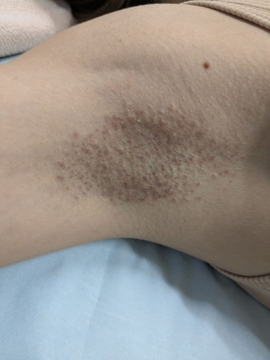 福岡のワキガ・多汗症治療症例 38歳女性 施術後14日目の右わきの状態