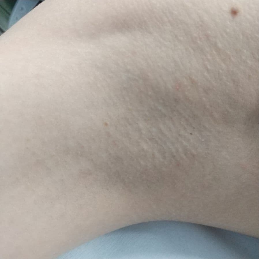 福岡のワキガ・多汗症治療症例 38歳女性 施術前の右わきの状態