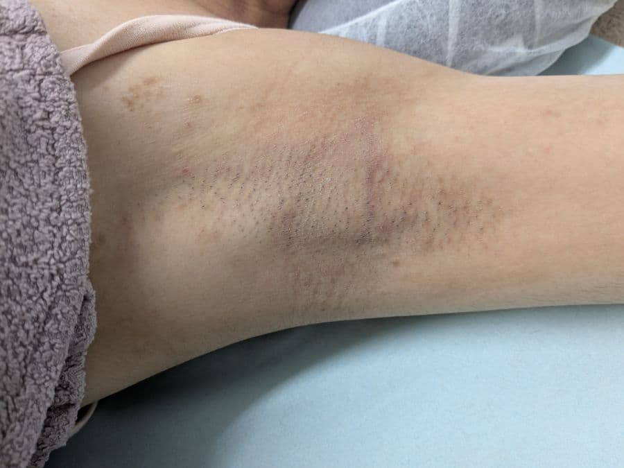 福岡のワキガ治療症例 31歳女性・医療従事者 施術後14日目の左わきの状態