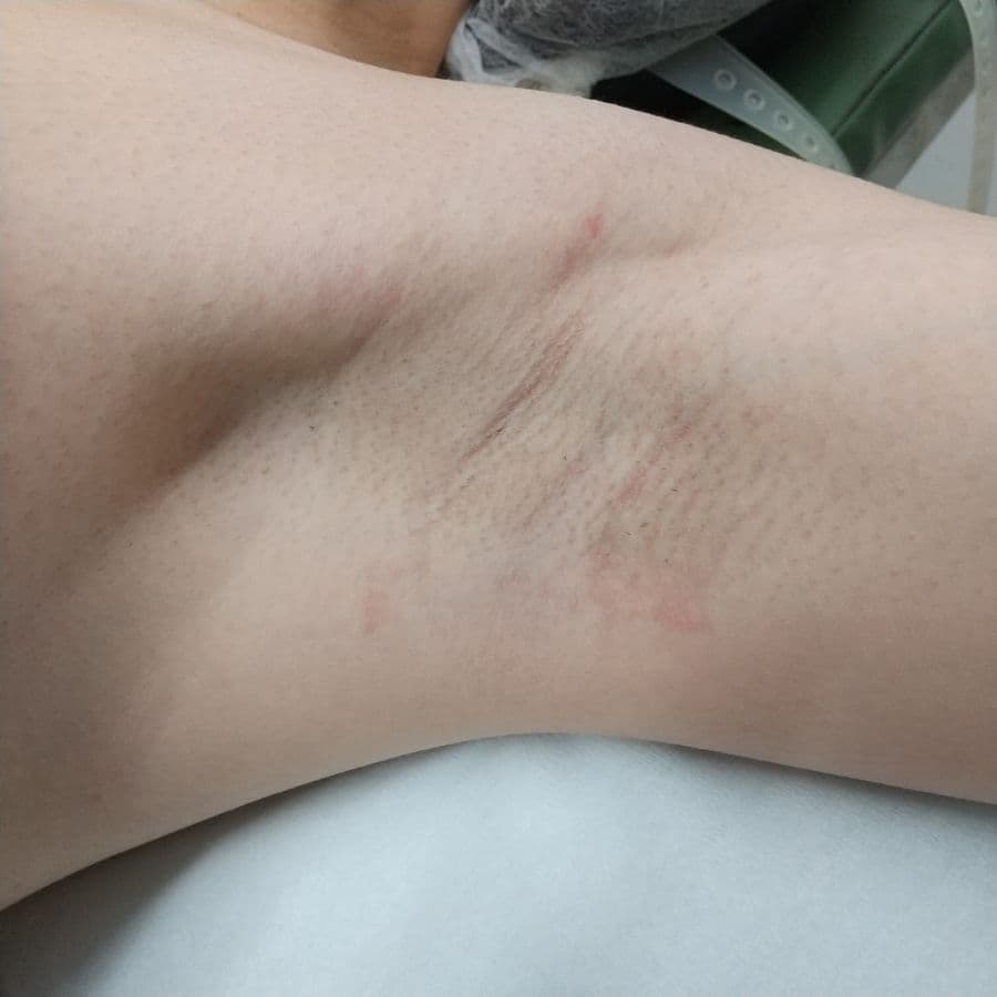 福岡のワキガ治療症例 31歳女性・医療従事者 施術前の左わきの状態