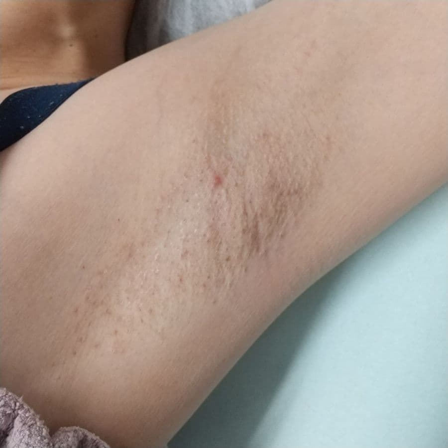 福岡の40代女性ワキガ治療症例 施術後14日目の左わきの状態