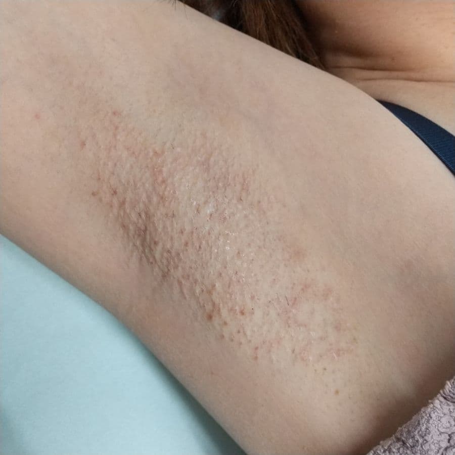 福岡の40代女性ワキガ治療症例 施術後14日目の右わきの状態