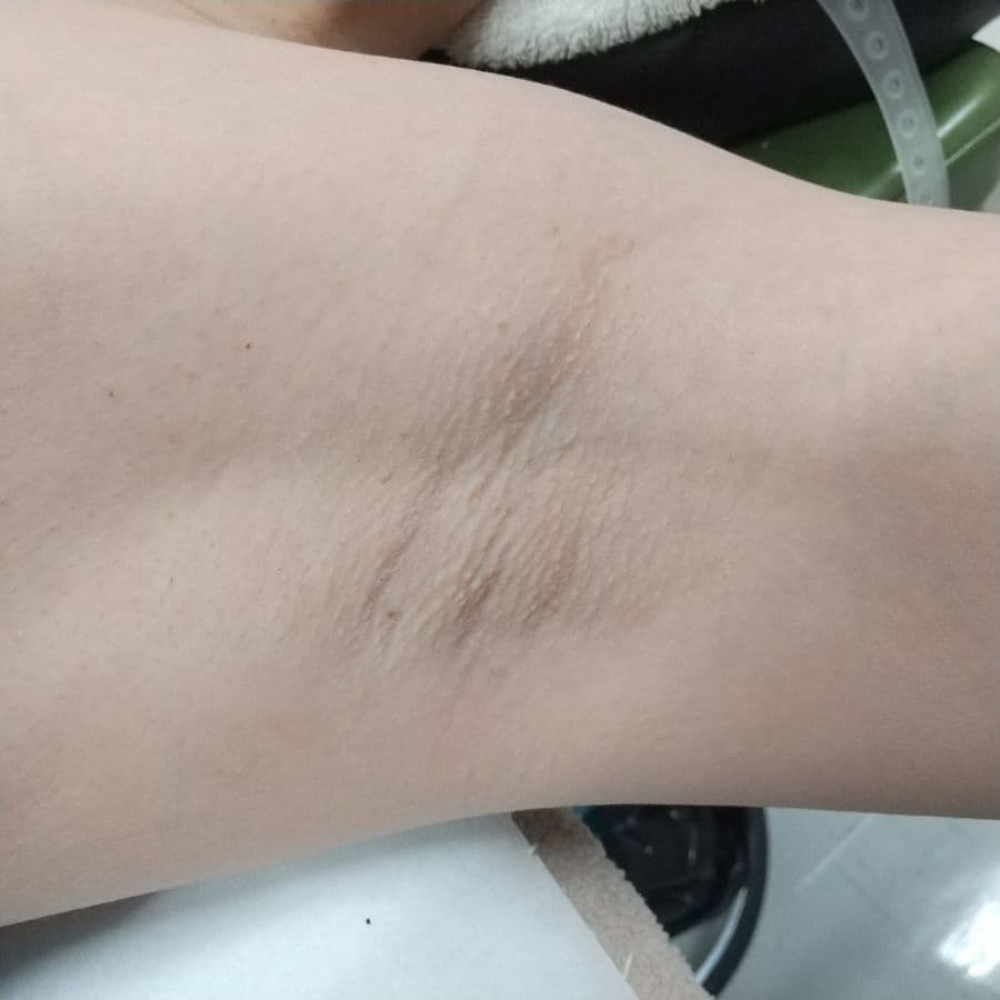 福岡の40代女性ワキガ治療症例 施術前の左わきの状態