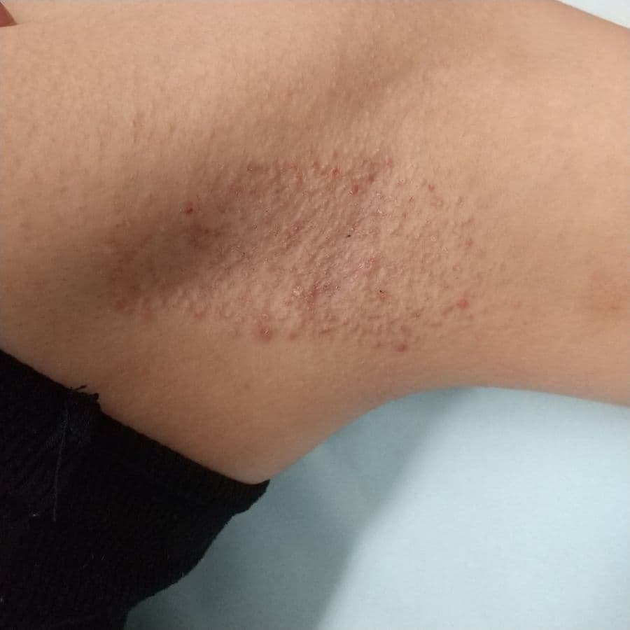 福岡のワキガ治療症例 23歳女性 施術後14日目の左わきの状態