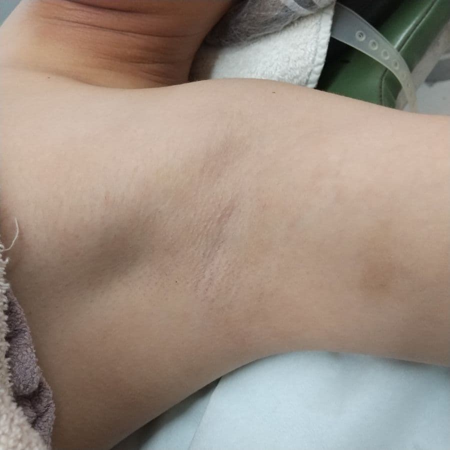 福岡のワキガ治療症例 23歳女性 施術前の左わきの状態
