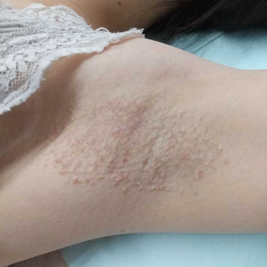 福岡のワキガ他院修正症例 26歳女性 施術後14日目の左わきの状態