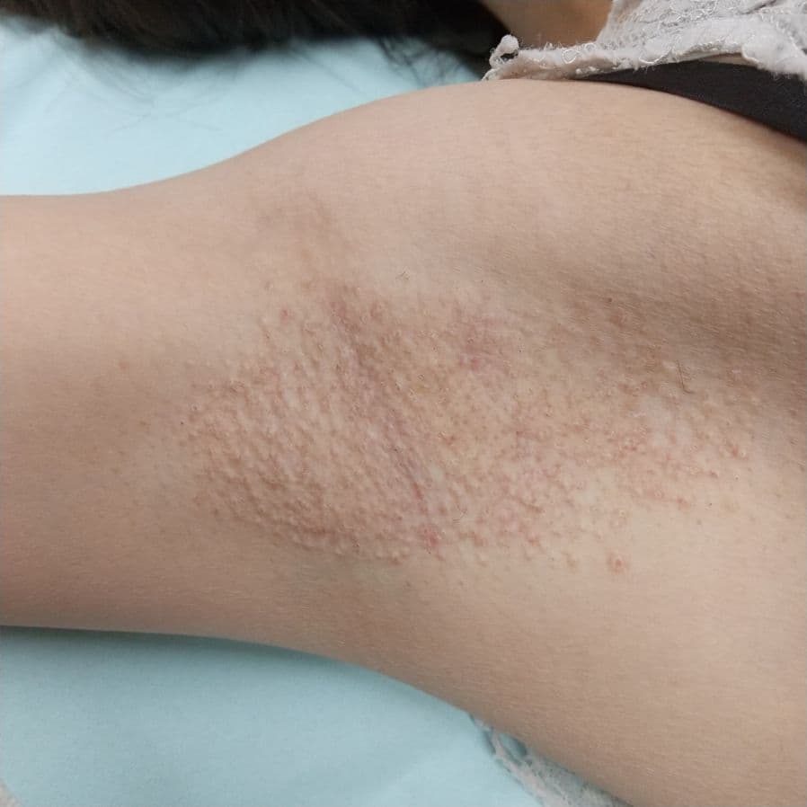 福岡のワキガ他院修正症例 26歳女性 施術後14日目の右わきの状態