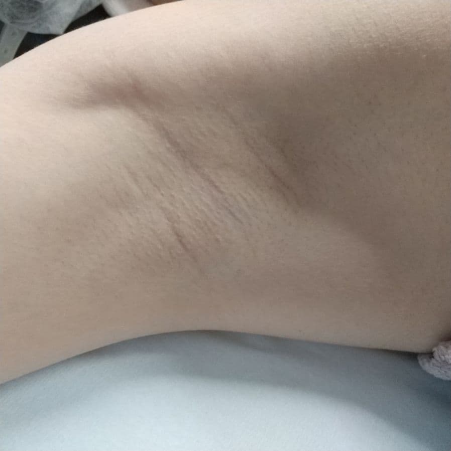 福岡のワキガ他院修正症例 26歳女性 施術前の右わきの状態